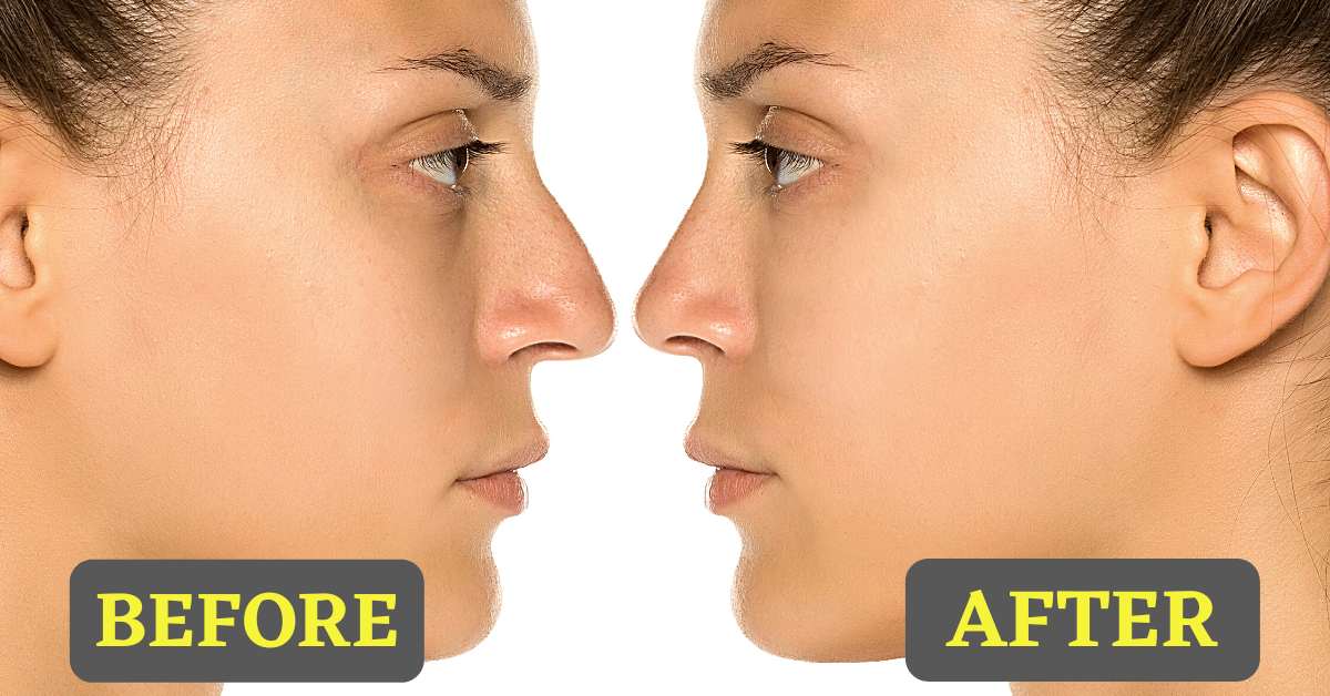 How to Fix a Crooked Nose: How to Save Time and Money - TipsFu