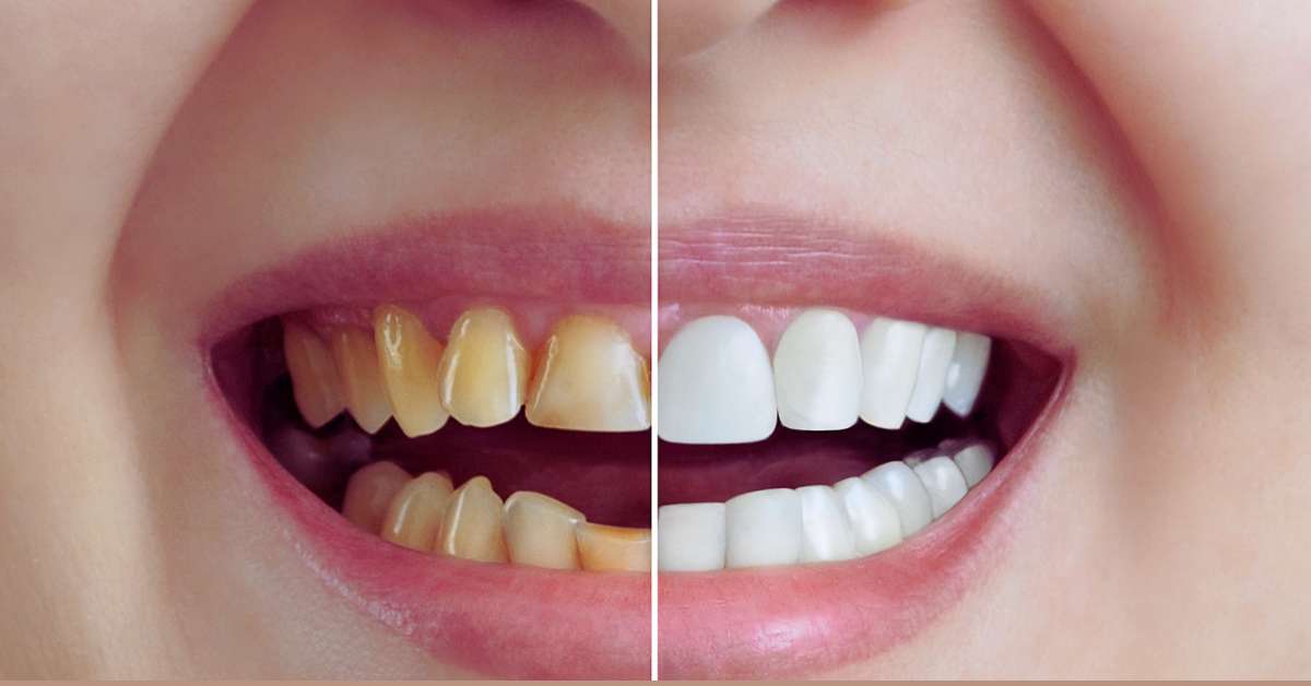 How Can I Make My Teeth Longer? Achieving Longer Teeth TipsFu