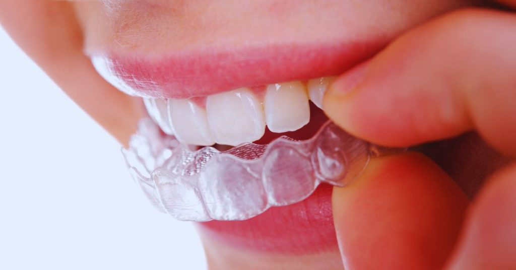 Can I Wear My Retainer After Wisdom Teeth Removal?